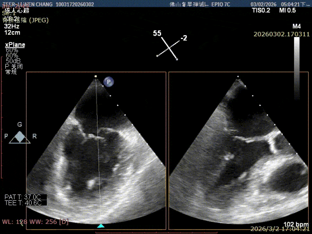 Color Doppler X-plane imaging showing severe mitral regurgitation before the procedure