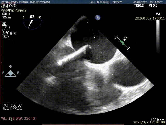 3D en-face transesophageal view of the mitral valve showing prolapse