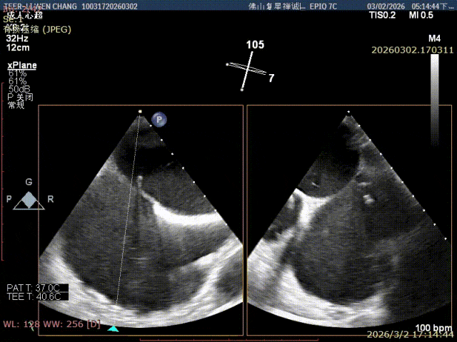 Transseptal puncture and guiding sheath placement under transesophageal echo guidance