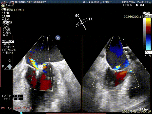 3D en-face view showing the double-orifice result after the first clip