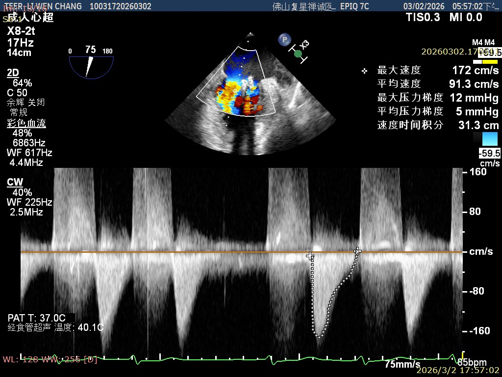 Continuous-wave Doppler measurement after the procedure showing a mean gradient of 5 mmHg